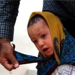 ملیکا یک نفر از هشت نفرِ مبتلا به ایکتیوز + عکس ملیکا یک نفر از هشت نفرِ مبتلا به ایکتیوز + عکس