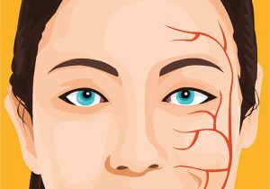 اختلالی که در زنان بالای ۴۰ سال شایع تر است و سمت چپ صورت را درگیر می کند (+عکس)